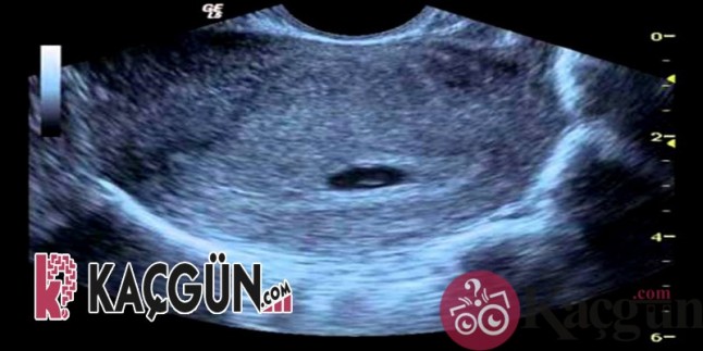 Ultrasonda Bebek Ne Zaman Görülür?