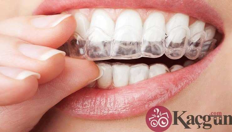 Diş Kaplaması Nasıl Yapılır? Kaç Gün Sürer?